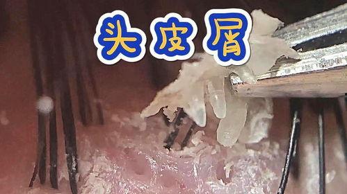抠头皮屑的视频,跟随视频探索头皮屑的成因与防治