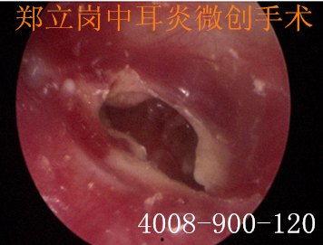 中耳胆脂瘤手术视频,中耳胆脂瘤手术全过程解析