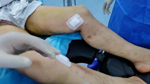 下肢静脉曲张手术视频,下肢静脉曲张手术全过程解析与要点回顾